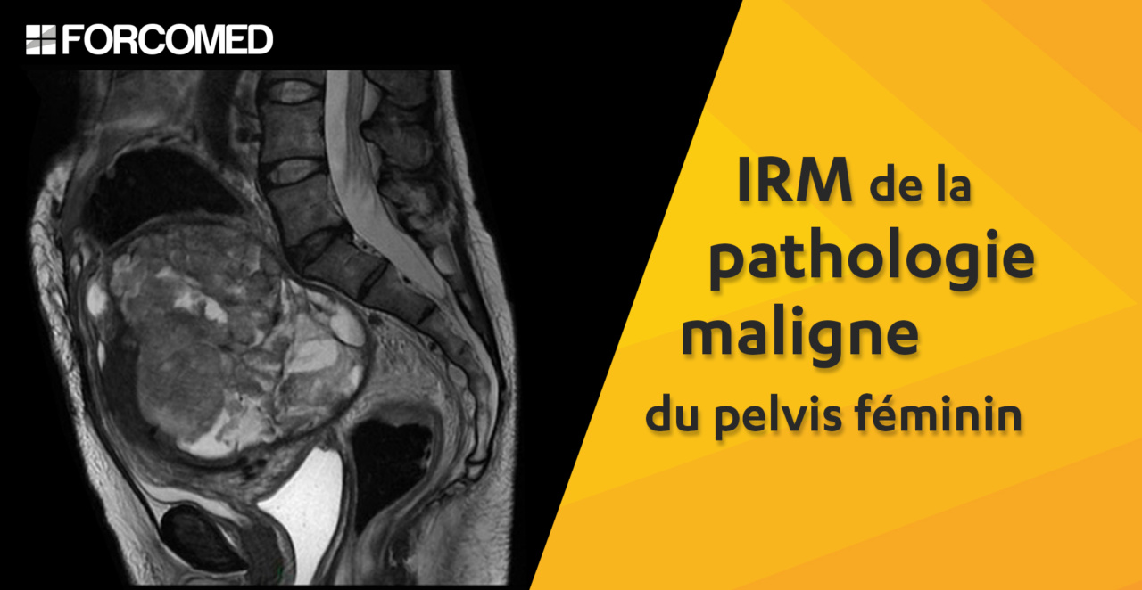 IRM de la pathologie maligne du pelvis féminin